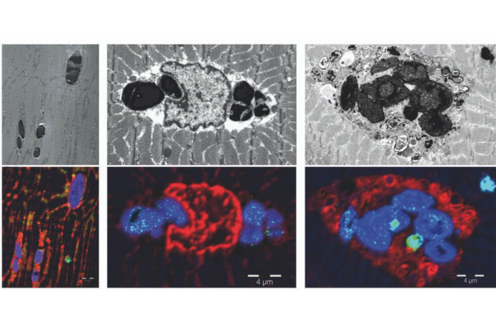 Descubren una nueva enfermedad muscular causada por una mutación genética