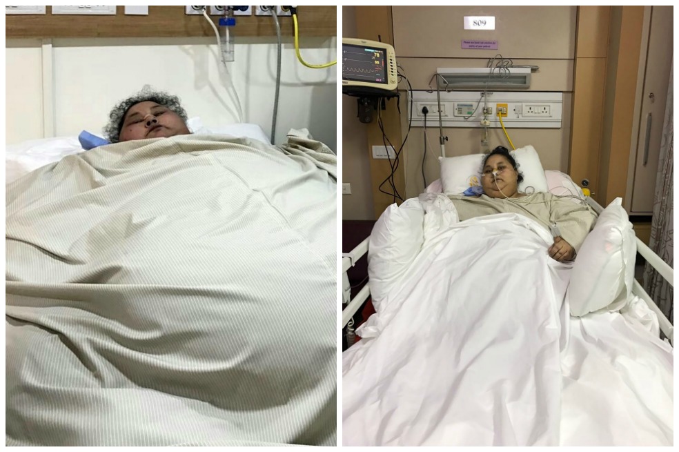 La mujer más obesa del mundo pierde 100 kilos tras una operación en India