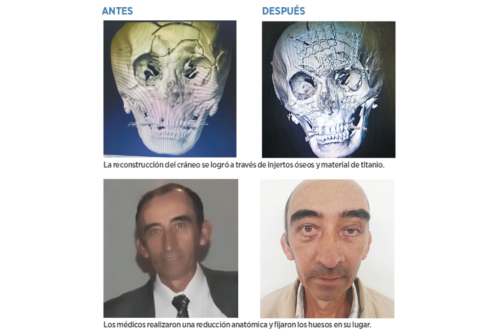Reconstruir el cráneo y el rostro de Henry fue armar un rompecabezas
