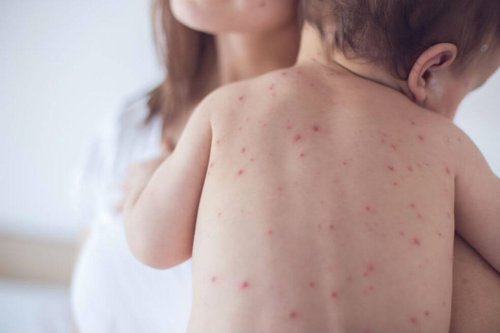 En lo que va de 2019 se han cuadruplicado los casos de sarampión en el mundo