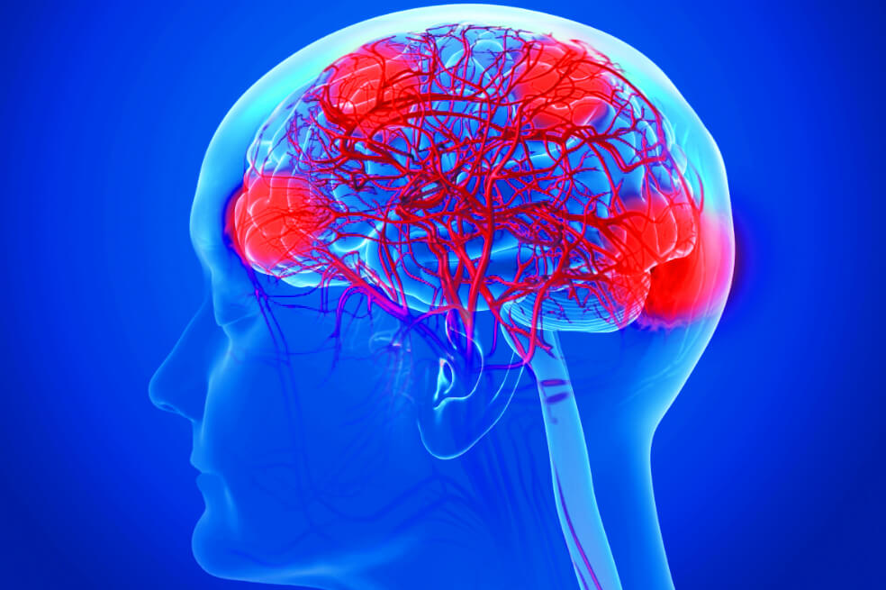 Señales que alertan de un  posible ataque cerebro-vascular