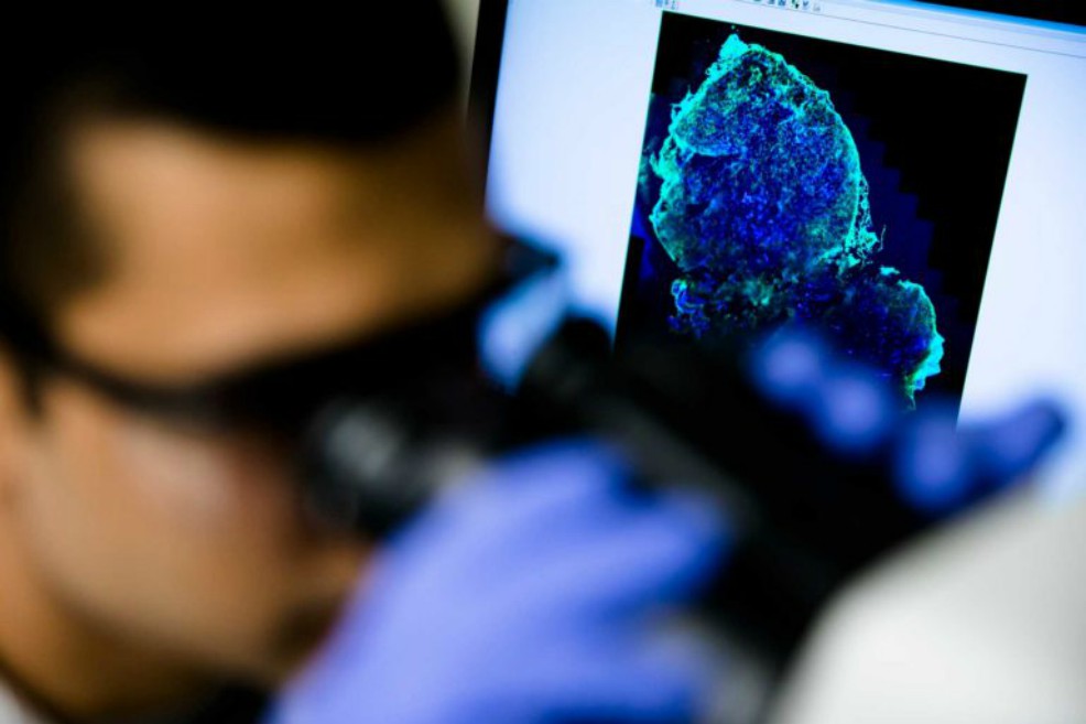 Píldoras para detectar el cáncer de mama en camino