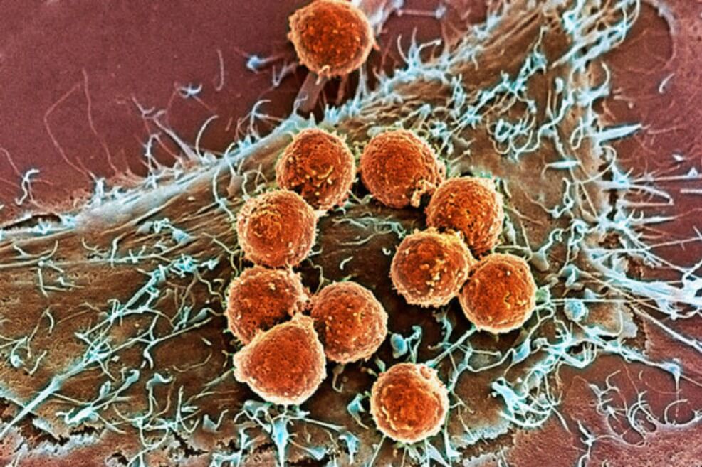 Por primera vez edición genética muestra seguridad en pacientes con cáncer
