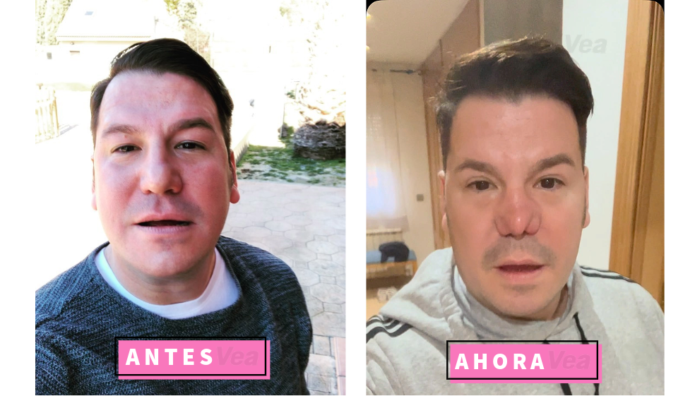 Miembro de Andy y Lucas luce irreconocible tras fallido procedimiento estético