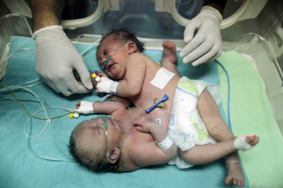 Una de las siamesas palestinas operadas se encuentra en estado de «muerte clínica»
