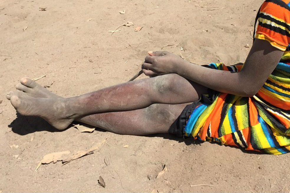 Aumenta el número de niños raquíticos en África, según informe de la OMS