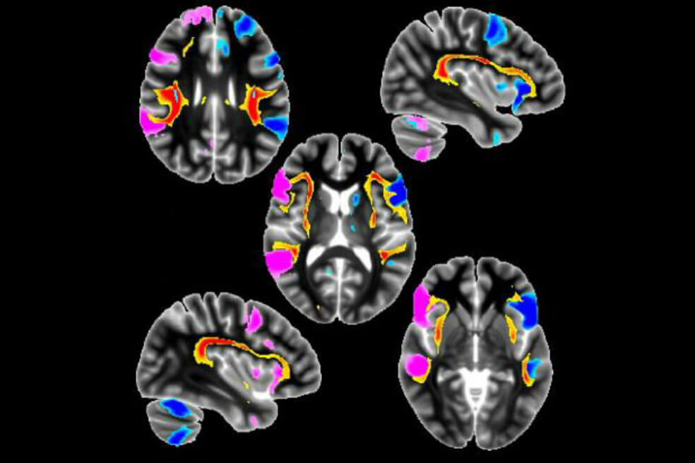 Los zurdos tendrían estructuras cerebrales y genéticas diferentes a las de los diestros