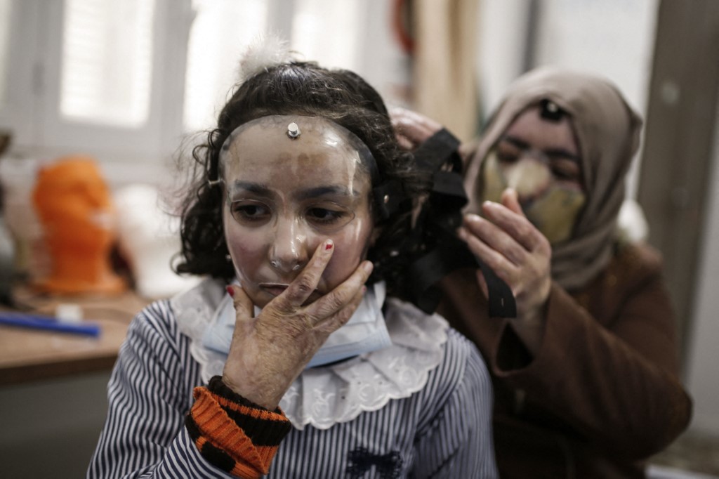 Máscaras impresas en 3D para curar rostros quemados en Gaza
