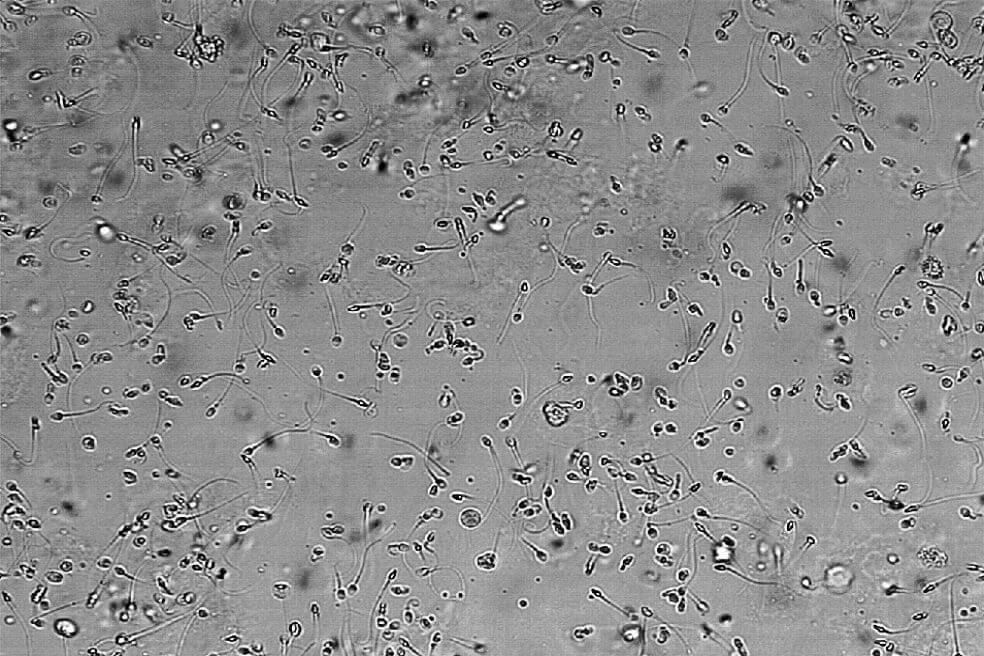 Paciente genera espermatozoides ajenos luego de recibir un trasplante de médula ósea