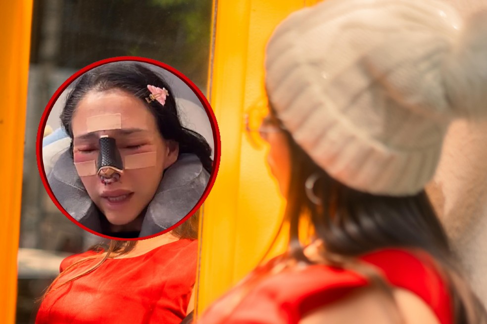 ⁠Reconocida modelo se desfiguró el rostro tras fallida rinoplastia: “Una mala experiencia”
