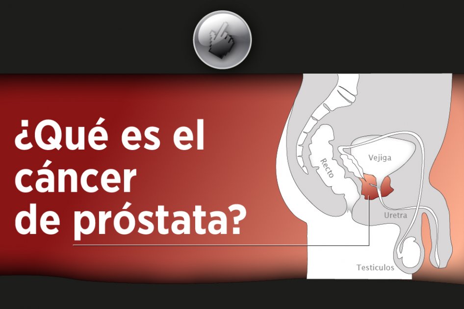 ¿Qué es el cáncer de  próstata?