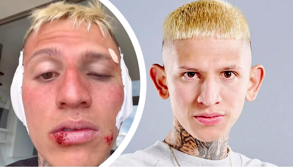 La Liendra explicó la razón de sus heridas en el rostro: “Casi pierdo mis orejitas”