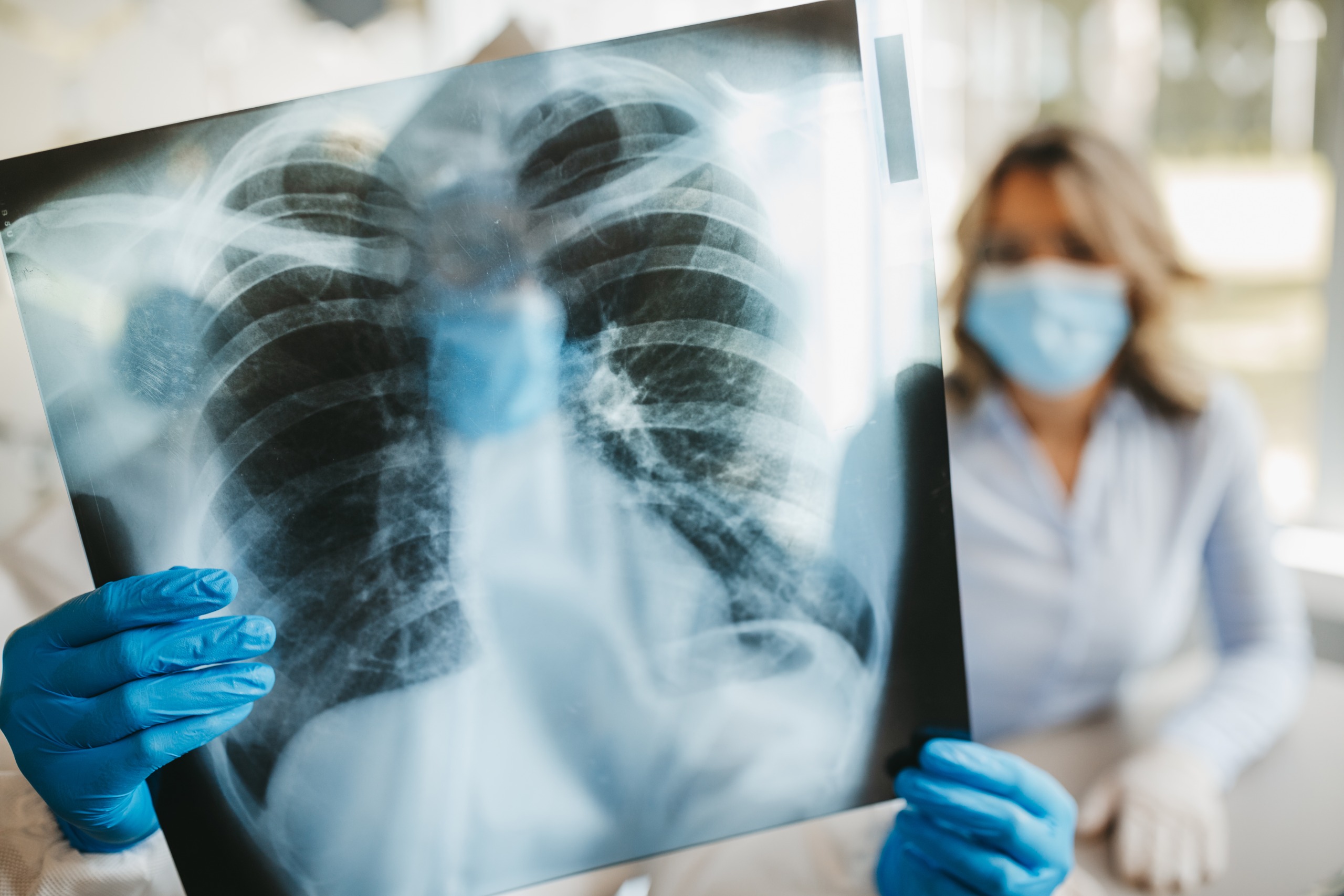 La OMS pide medidas urgentes ante interrupciones en servicios de tuberculosis