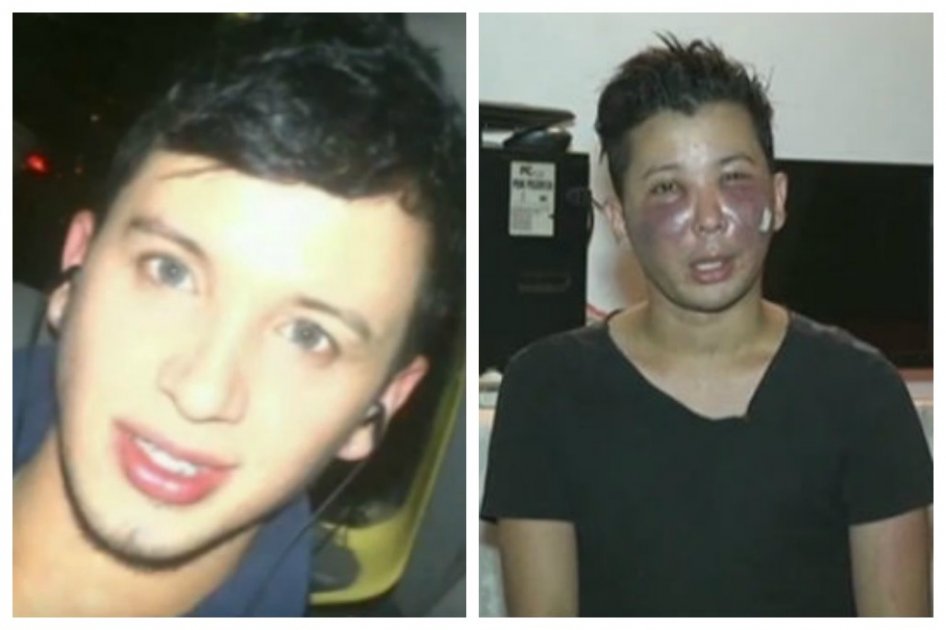Procedimiento estético irregular le desfiguró el rostro a joven en Cali