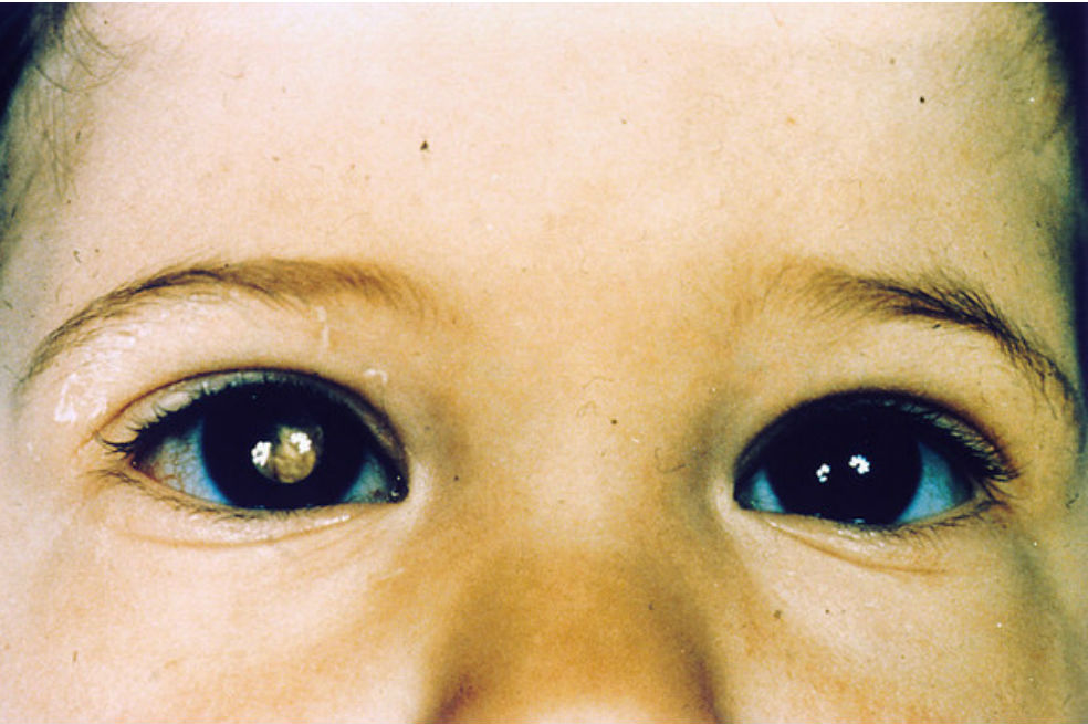 Un fármaco biológico para tratar el cáncer de retina en niños