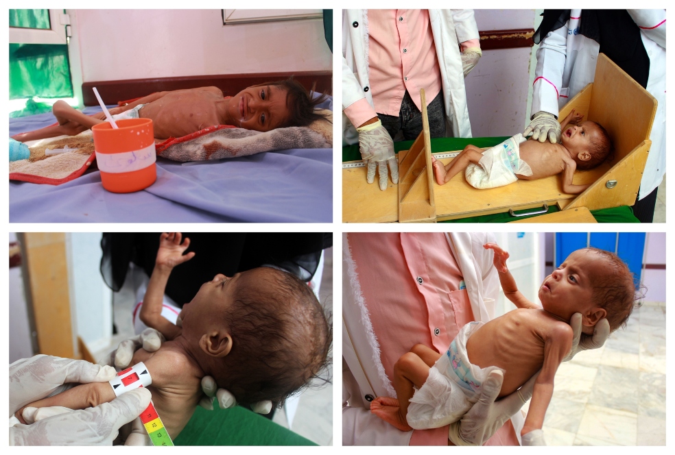El Espectador le explica: Yemen, donde la guerra mata a los niños de hambre