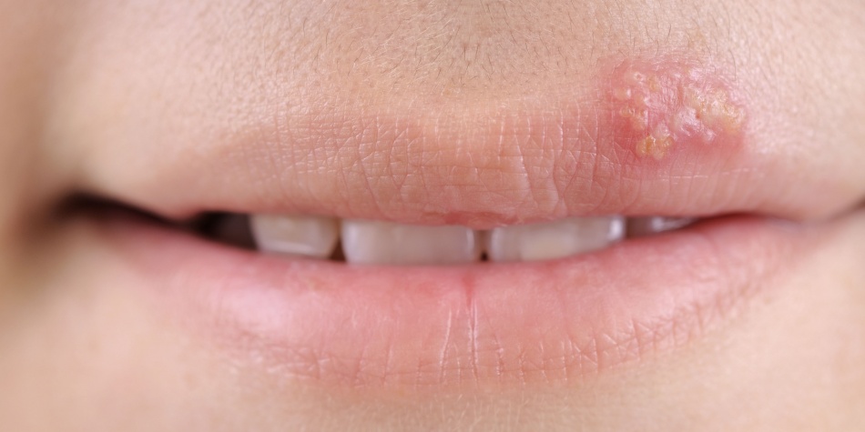 6 cosas que el herpes labial dice sobre tu salud