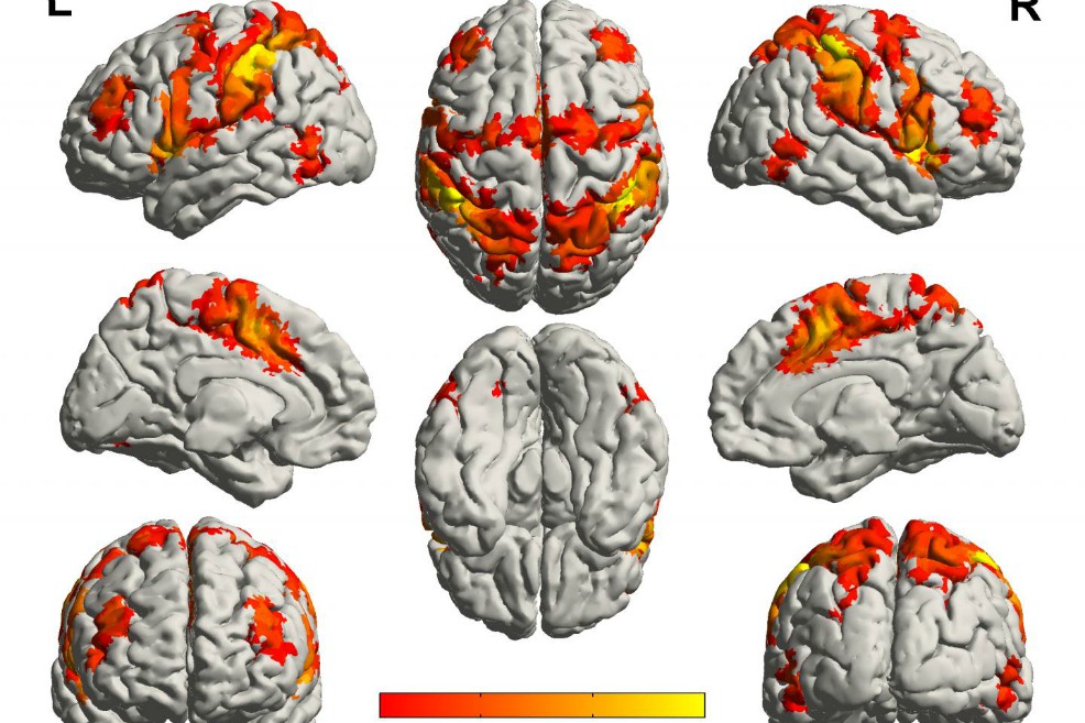 Pacientes con Alzheimer podrían disfrutar su música favorita