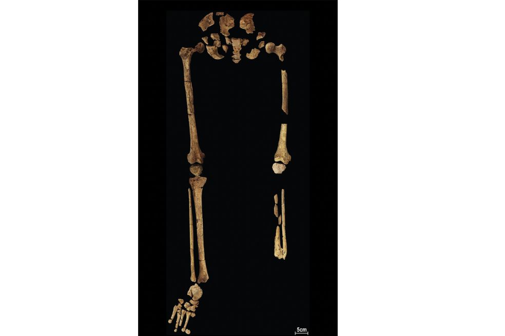 La primera amputación quirúrgica exitosa fue hace 31.000 años
