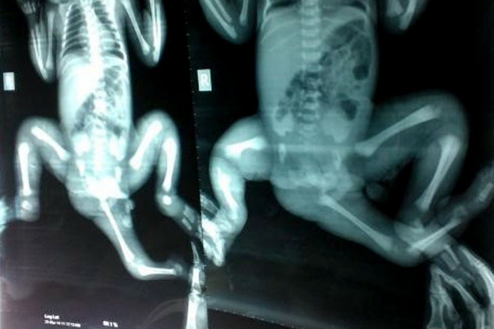 Nueva vida para una niña de Bangladés nacida con tres piernas