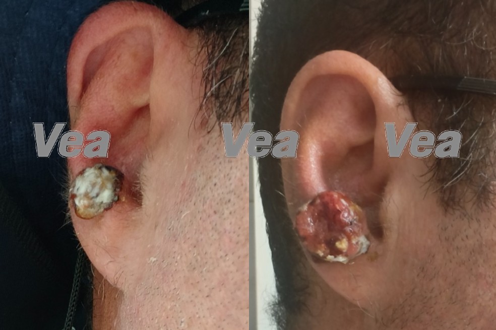 Tumor de Andrés Bejar.