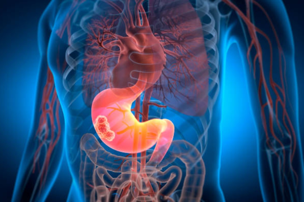 Cáncer de páncreas: nuevo medicamento duplica la supervivencia, pero debe verse con cautela