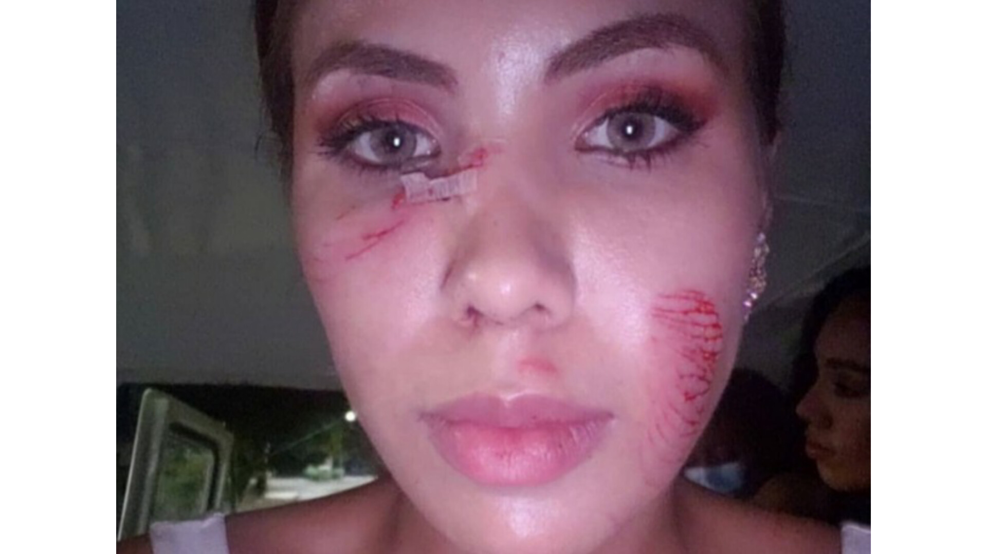 Maria Del Mar Meza sufrió un accidente en su rostro con un dron.