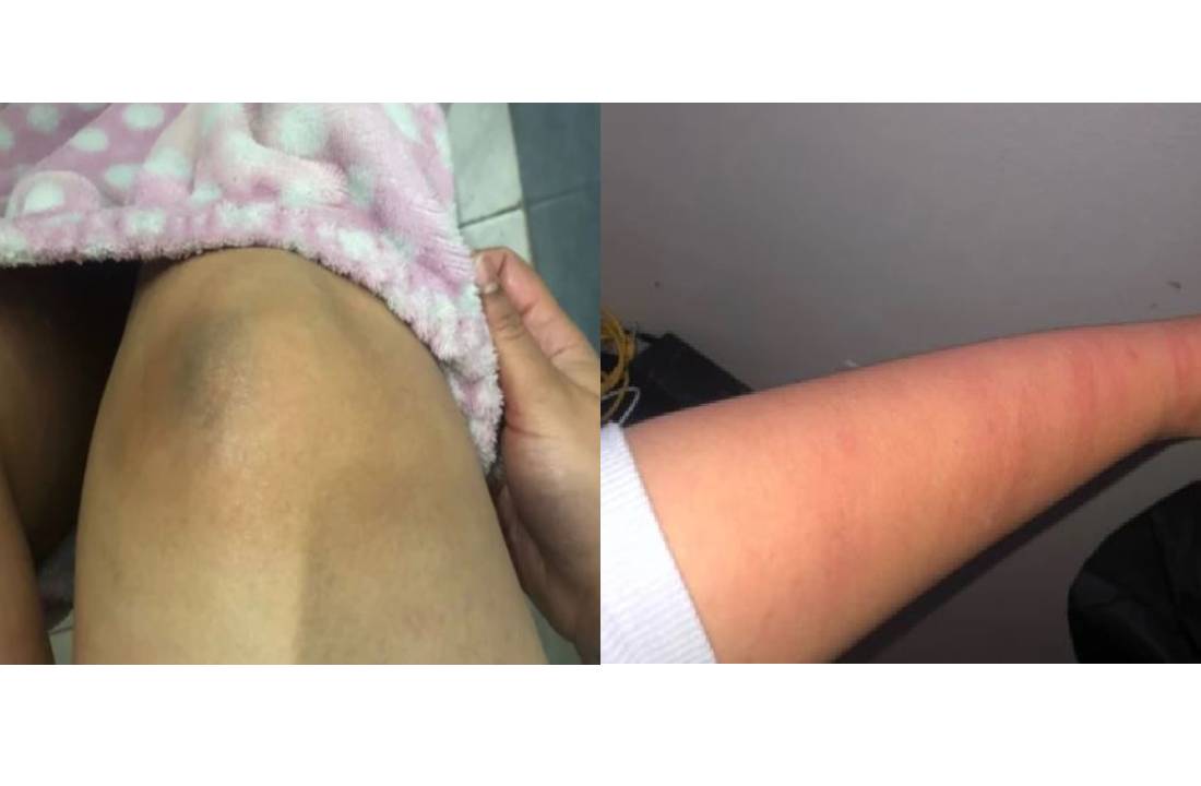La mujer resultó con golpes en una de sus rodillas y brazos. / Tomada de Blu Radio.