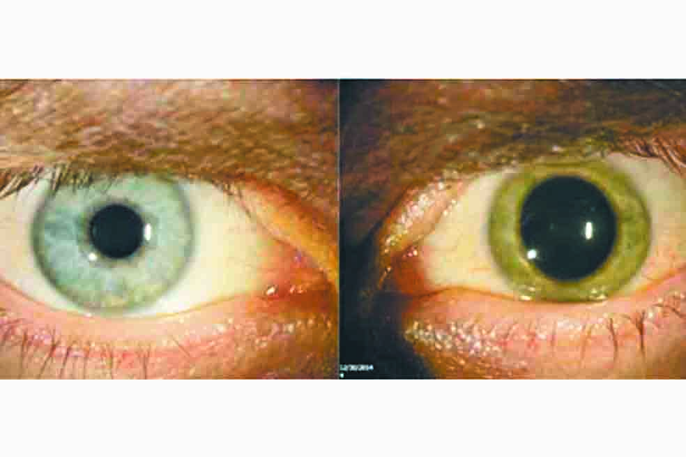 Con rastros del ébola en los ojos