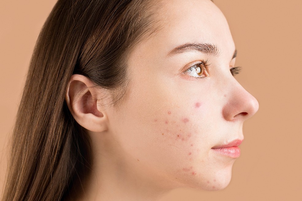 ¿Funciona la crema dental en los granos? Esto es lo que dicen los dermatólogos