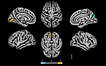 Un hombre perdió la capacidad de hablar. Este implante cerebral le regresó su voz