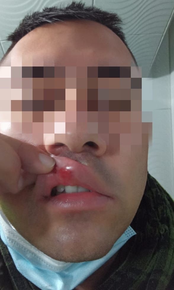 Lesión causada a patrullero que recibió un cabezazo del funcionario del Inpec.