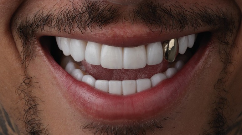Dientes de oro y grillz, la moda de los años 80 que regresa en el 2024