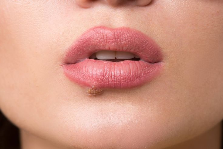 ¿Por qué salen los fuegos en los labios y cómo se quitan?