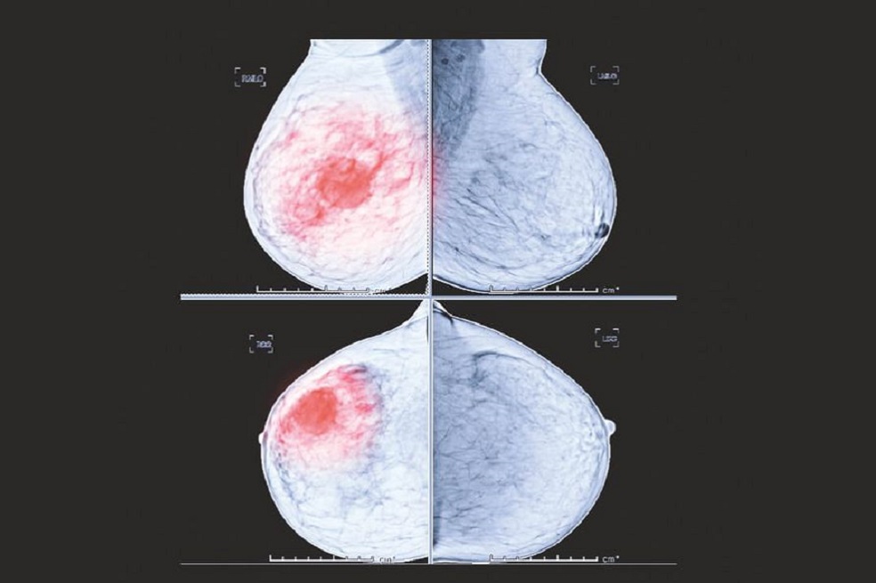 Los infartos cardíacos pueden acelerar el cáncer de seno