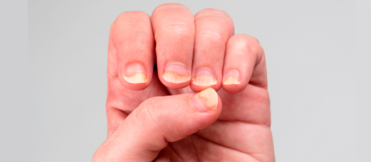 Uñas de Terry: qué son, cómo se ven y qué las causa