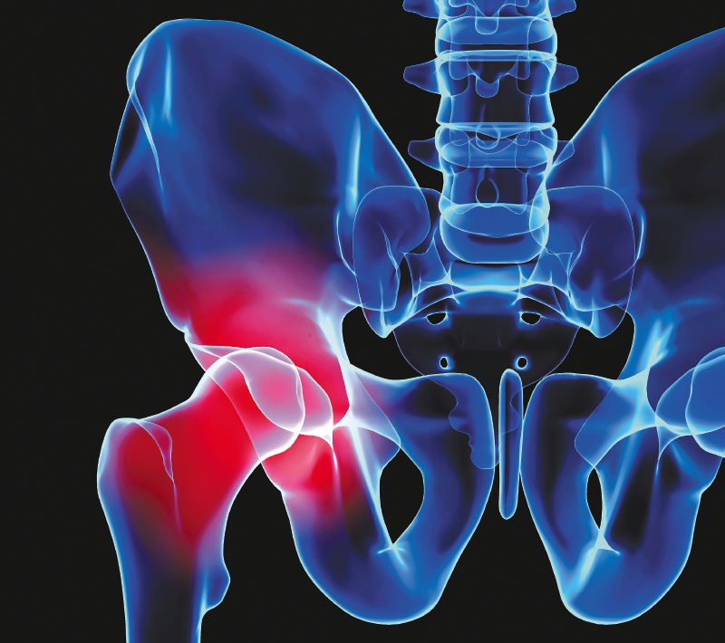 Osteoporosis: un problema silencioso que el sistema de salud no está detectando