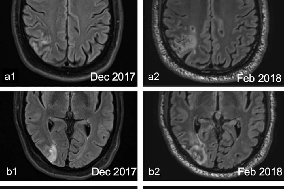 El caso del hombre que ve el mundo en miniatura tras sufrir un accidente cerebrovascular