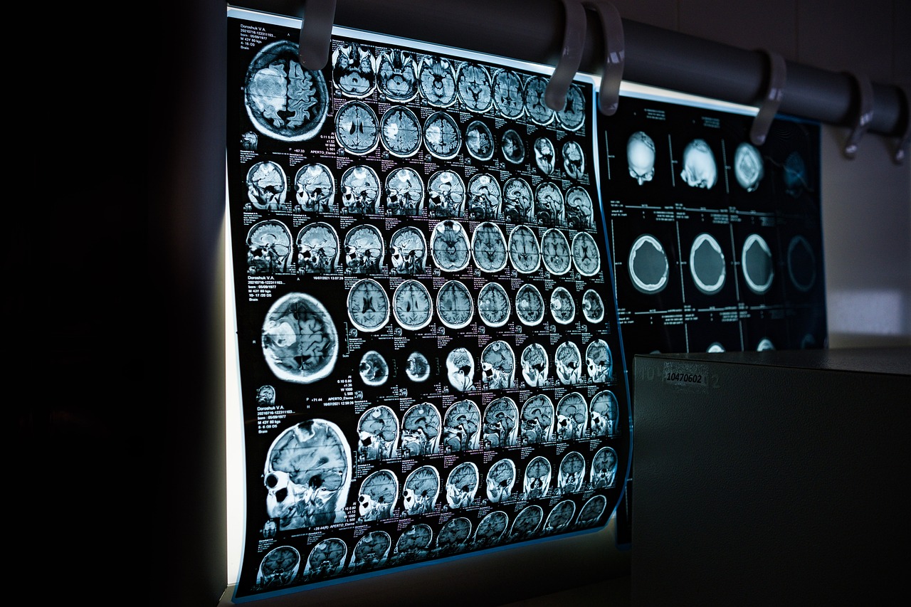 Inteligencia artificial podría diagnosticar el cáncer con el doble de precisión