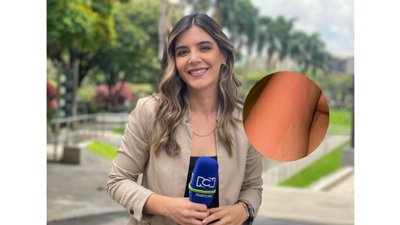 Isabella Atehortúa reveló el problema de piel que tiene hace 10 años
