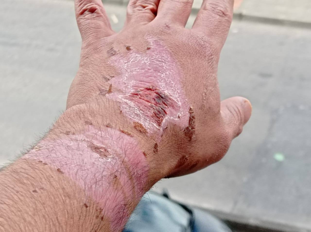 Foto de la quemadura en servicio de uno de los excocineros de El Monte Teepe Hostel.