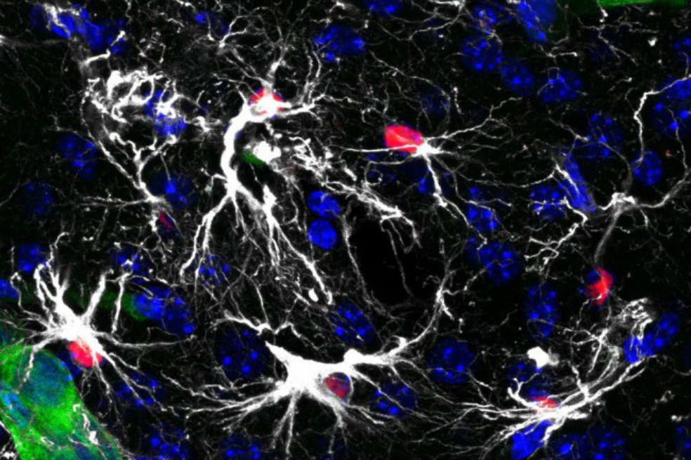 Incrementan la supervivencia de 4 a 15 meses en pacientes con metástasis cerebral