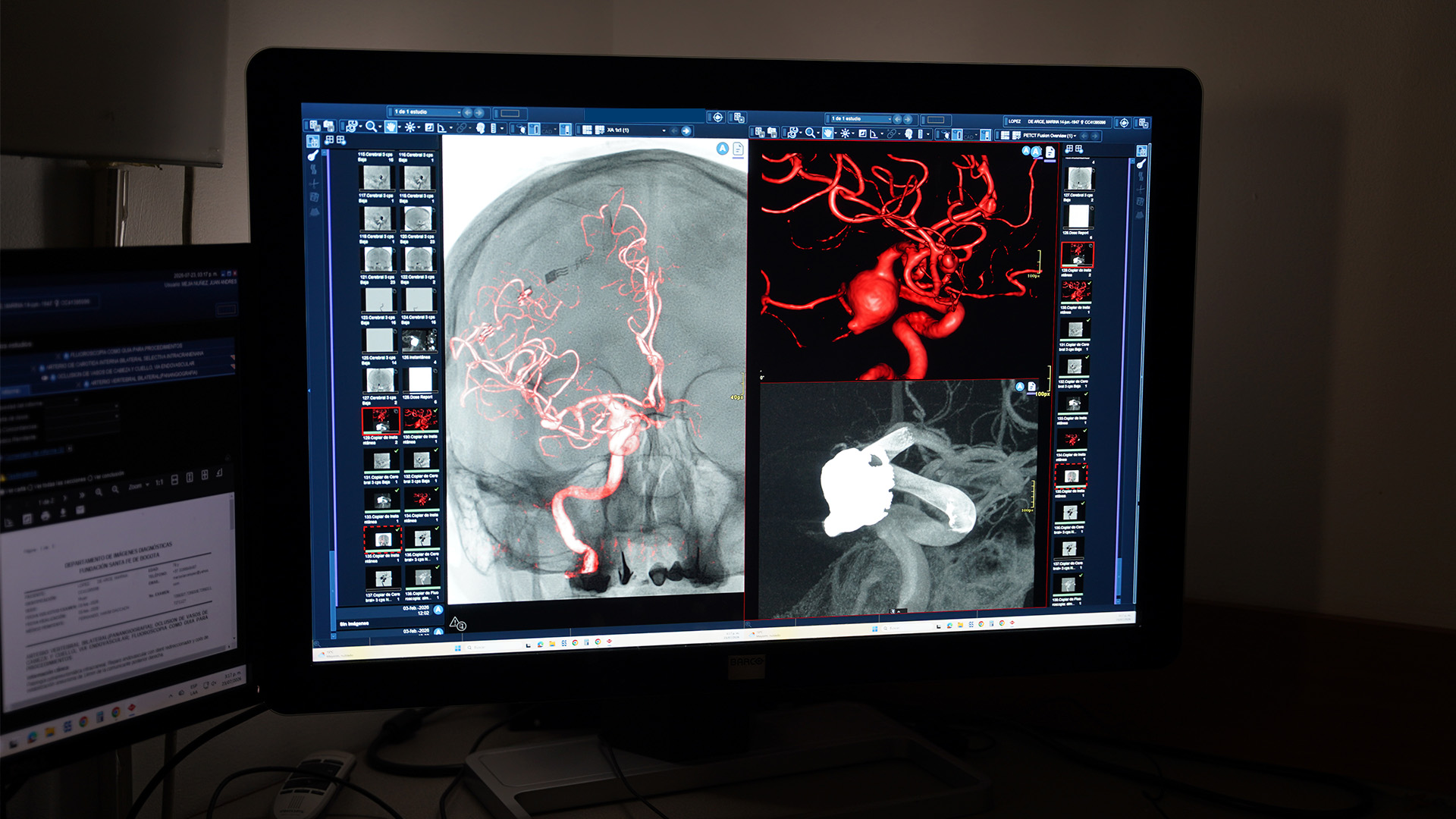 Aneurisma cerebral: factores de riesgo, detección y tratamiento