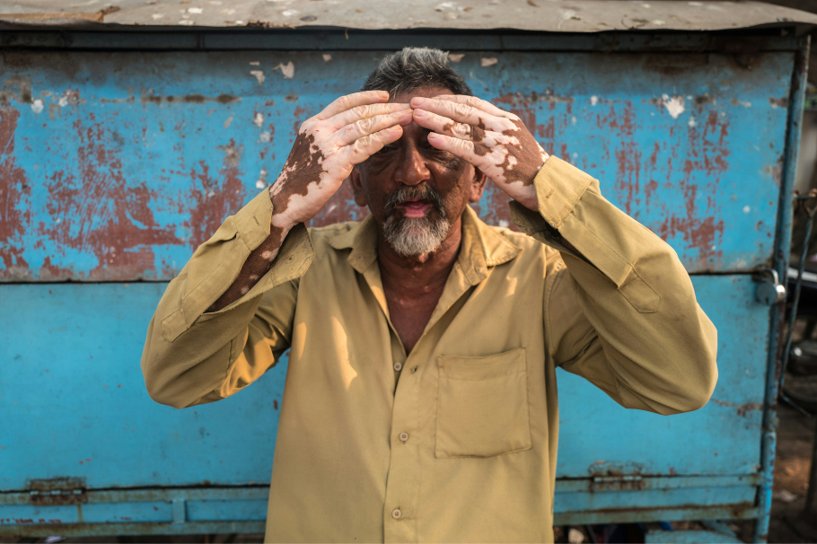 ¿Tiene vitiligo? El estrés puede ser un desencadenante: esto dicen los expertos