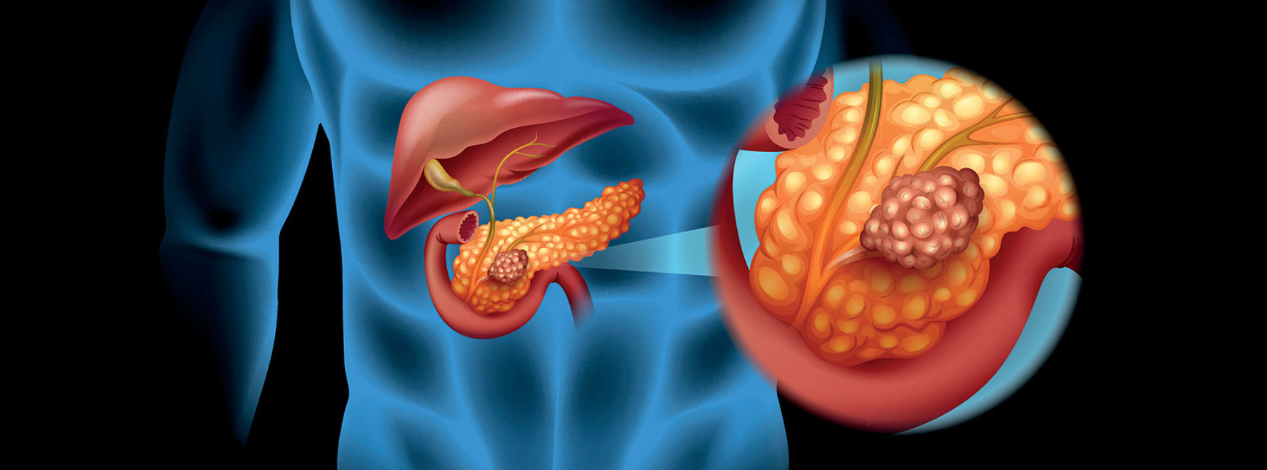 Importante revista retira estudio sobre cáncer de páncreas por conflicto de intereses