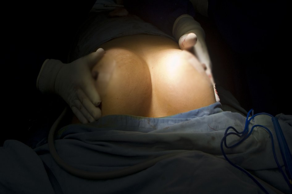 Miles de colombianas, víctimas de firma francesa de implantes mamarios