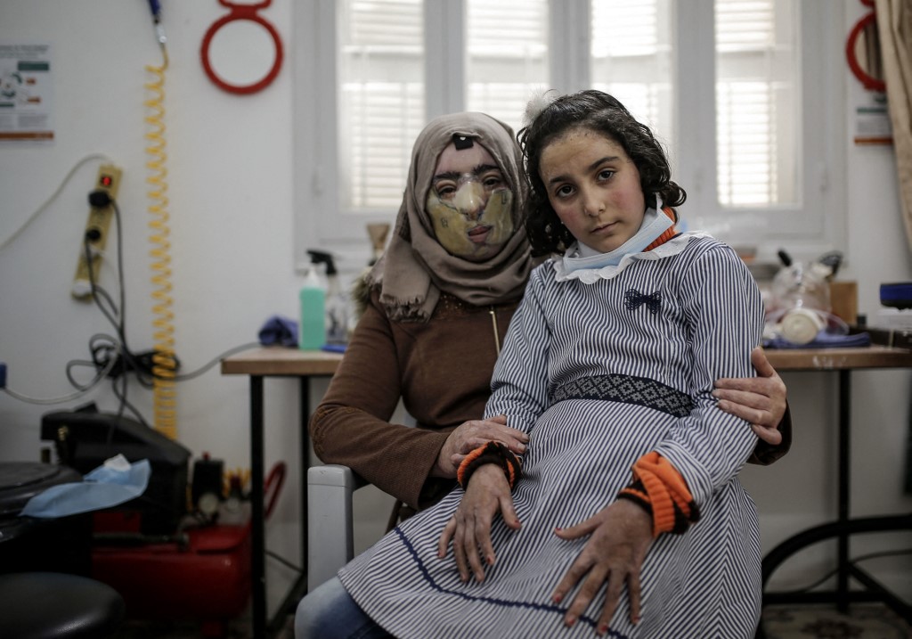 Maram y su madre Izdihar al-Amawi posan para la cámara después de comenzar máscaras de plástico diseñadas por Médicos sin Fronteras para cubrir las quemaduras del rostro.