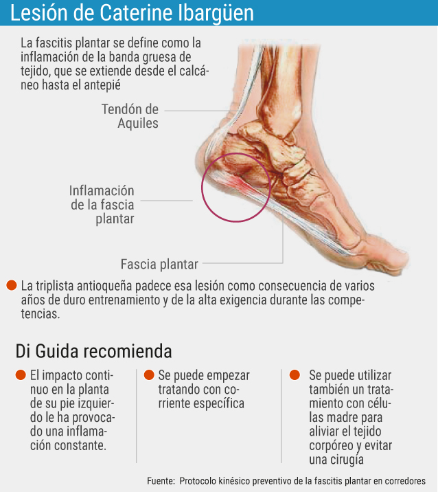 Dibujo del pie para ubicar la fascia plantar que queda en la planta del pie. La lesión de fascitis plantar inflama y duelo mucho.