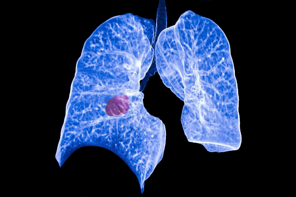 Las revelaciones del estudio sobre el cáncer más complejo de la historia