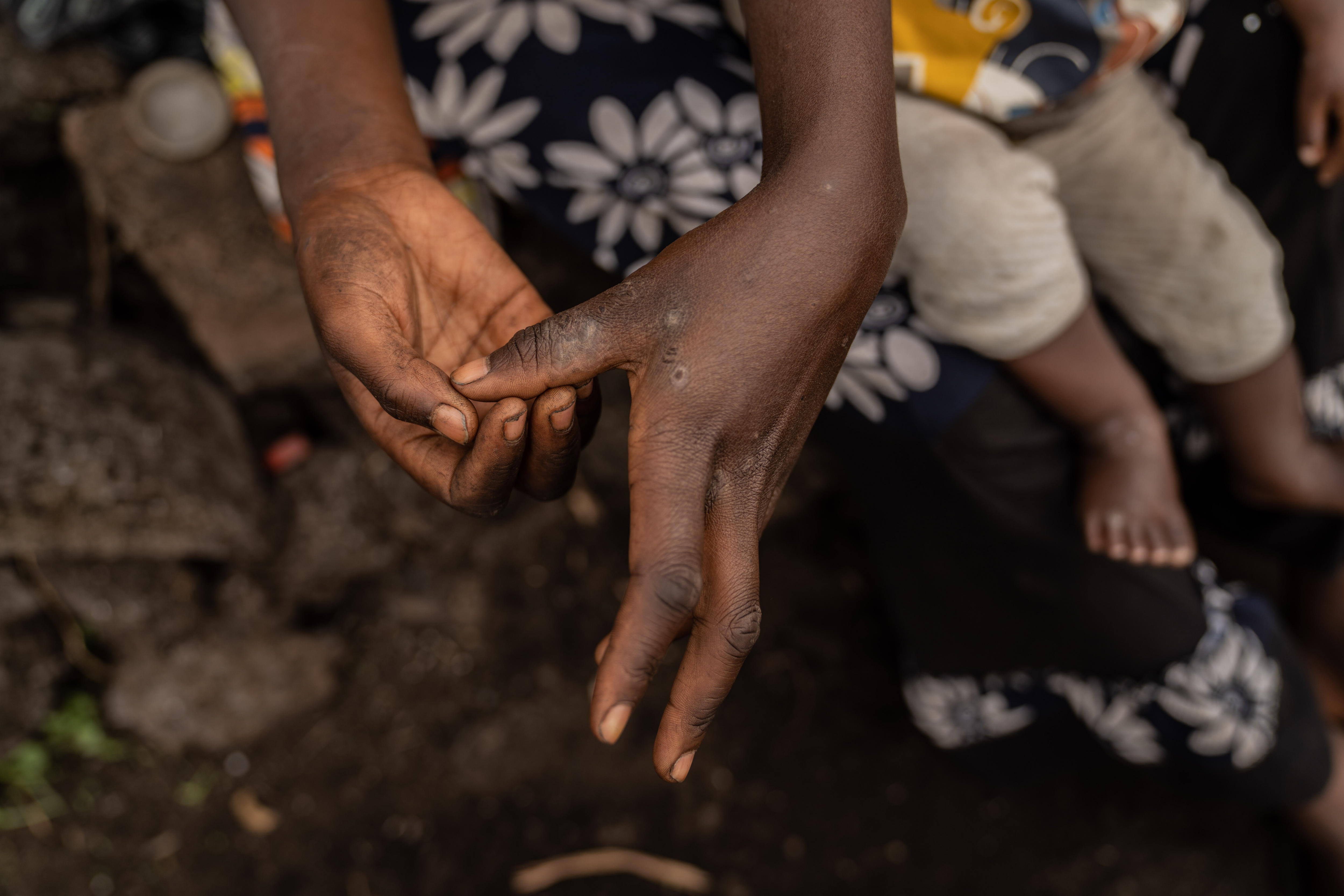 Confirman segundo caso de mpox o viruela símica clado Ib en Colombia